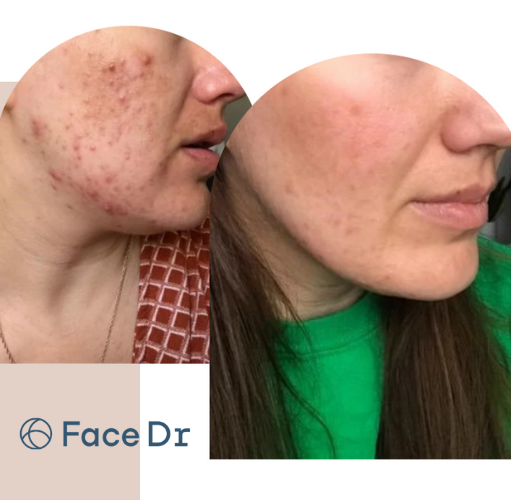 Cost to treat acne properly before and after image Face Dr