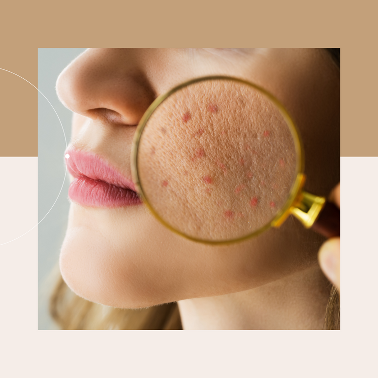 Signs of Damaged Skin Barrier